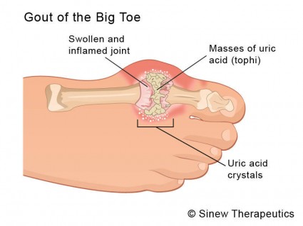 Kaitan Antara Penyakit Gout & Gula Big Toe
