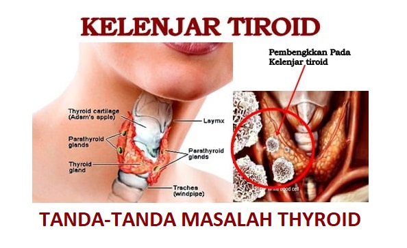 Masalah Gangguan Thyroid & Pemakanan