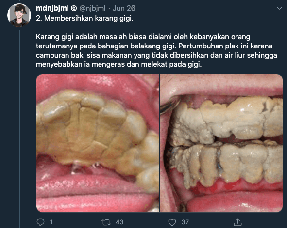 Gusi Saya Asyik Berdarah Bila Doktor Gigi Kongsi 4 Kebaikan Buat Scaling 6 Bulan Sekali Islam Itu Indah